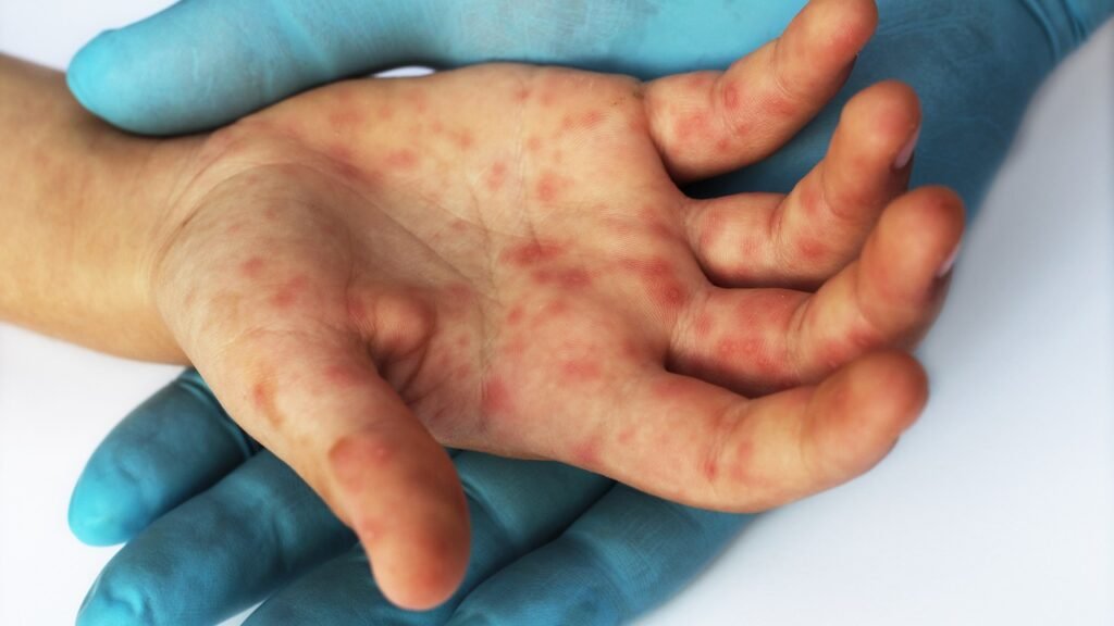 Potential Measles Exposure Reported in Downtown Bethesda
